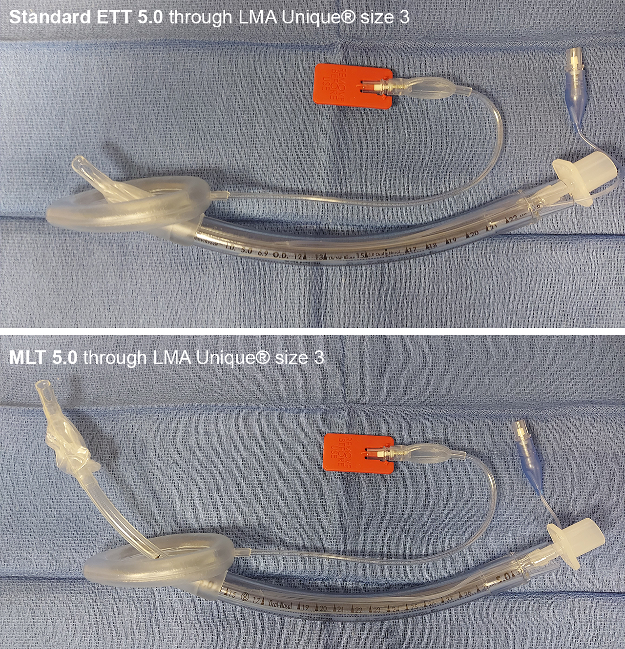 Intubation Through An SGA Anesthesia Airway Management AAM